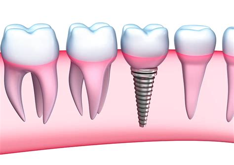 excel dental|Ozark Tooth Replacement Dentist 